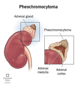 1707254660 23373 pheochromocytoma