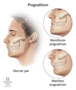 1707270013 22872 Prognathism