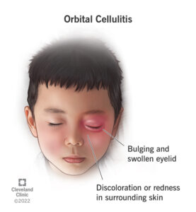 1707281534 24499 orbital cellulitis