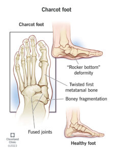 1707385338 15836 charcot foot