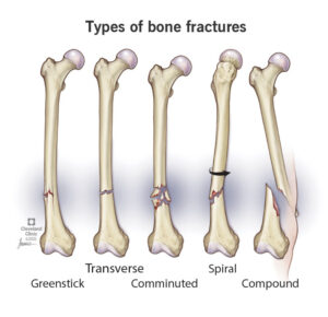 1707393018 22241 spiral fractures