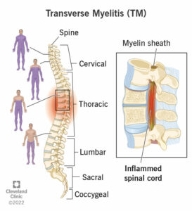 1707412282 8980 transverse myelitis