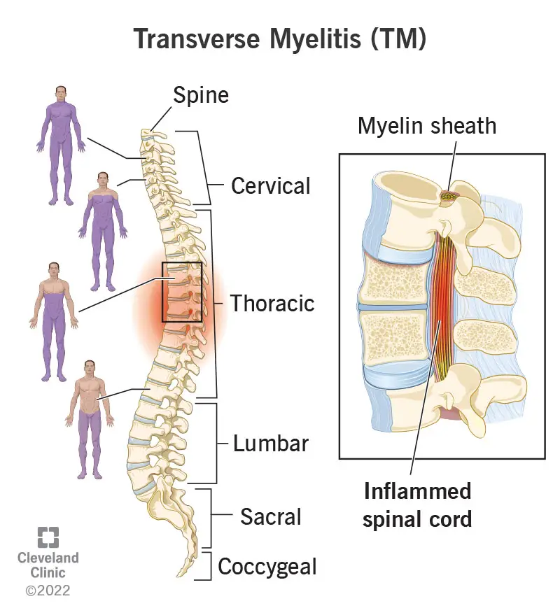 1707412282 8980 transverse myelitis