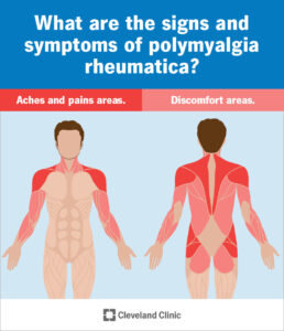 1707439215 25215 polymyalgia rheumatica infographic