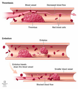 1707500787 22242 thrombosis illustration