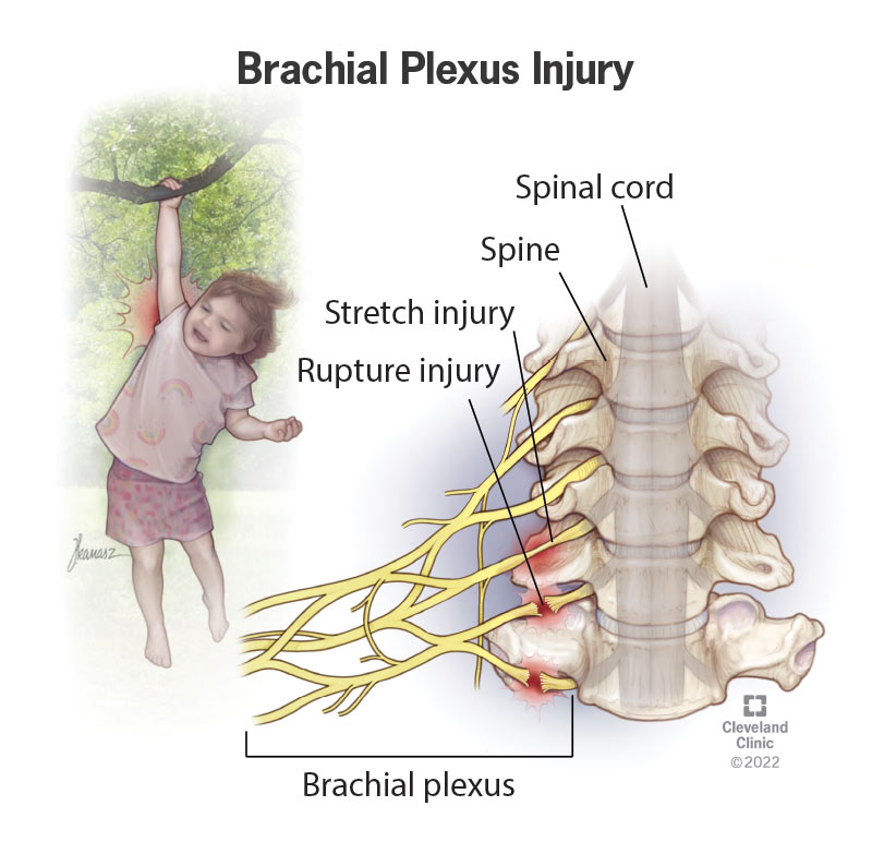 1707516138 22822 brachial plexus injury