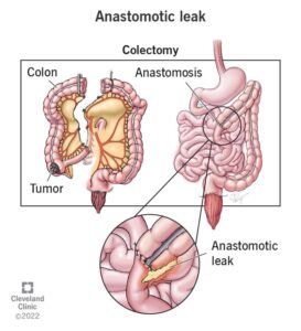 1707550815 22324 anastomotic leak