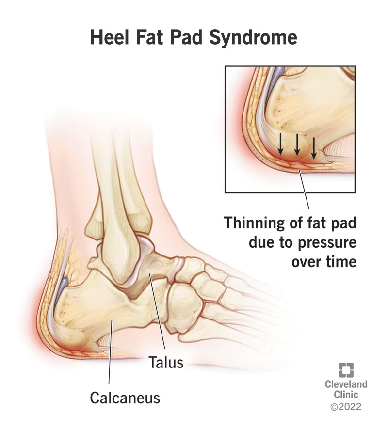 1707570135 23275 heel fat pad syndrome