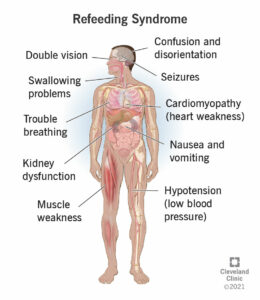 1707635655 23228 refeeding syndrome