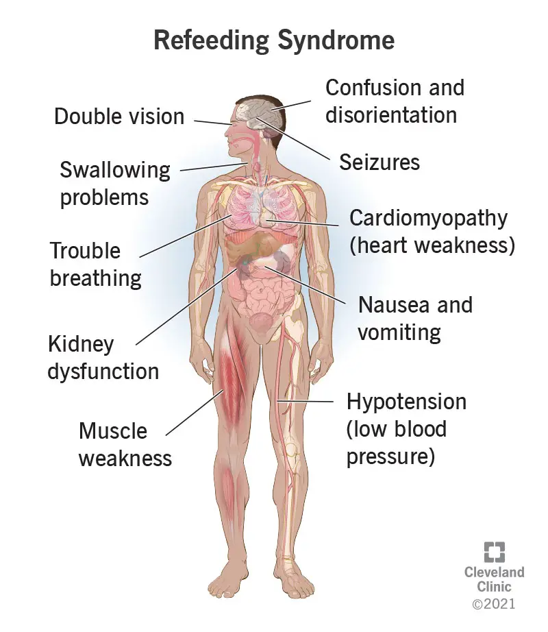 1707635655 23228 refeeding syndrome