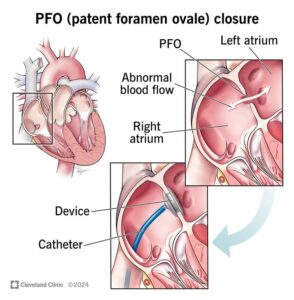 1707677994 17326 patent foramen ovale