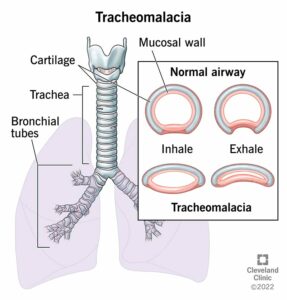 1707693467 24504 tracheomalacia