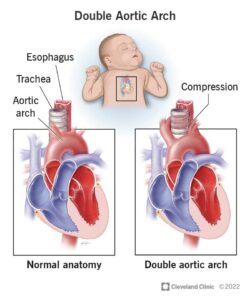 1707720387 23432 double aortic arch