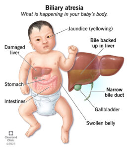 1707801921 21076 biliary atresia