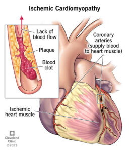 1707825081 17145 ischemic cardiomyopathy illustration