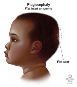 1707886821 10691 plagiocephaly