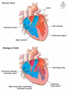 1707960979 22343 tetralogy of fallot