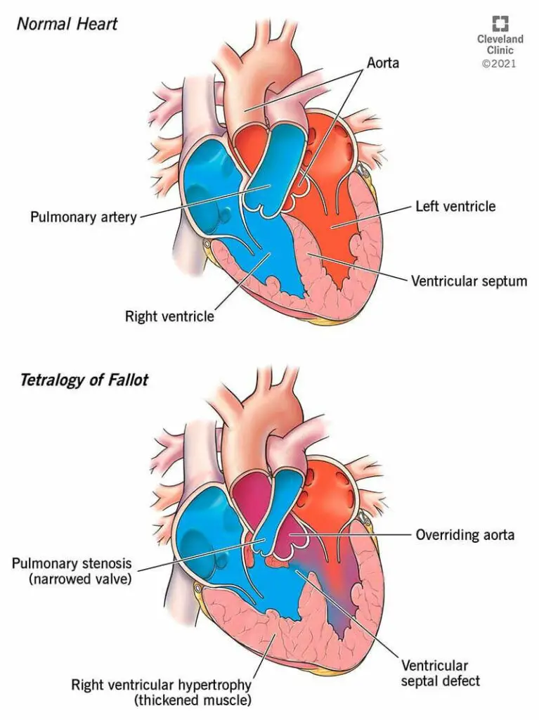 1707960979 22343 tetralogy of fallot