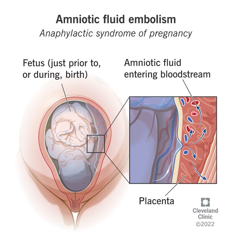 1708011020 15463 amniotic fluid embolism
