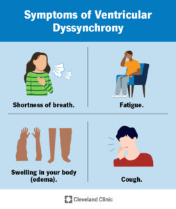 1708022596 24279 ventricular dyssynchrony cv