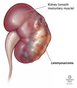 1708034173 22059 leiomyosarcoma illustration