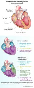 1708068856 17643 wolff parkinson white syndrome