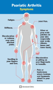 1708103837 13286 psoriatic arthritis infographic