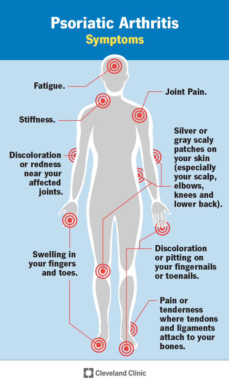 1708103837 13286 psoriatic arthritis infographic