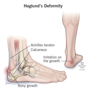 1708107735 25134 haglunds deformity