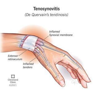 1708142295 23448 tenosynovitis