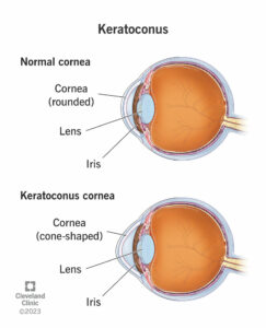 1708173076 keratoconus