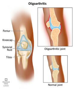 1708207733 23929 oligoarthritis