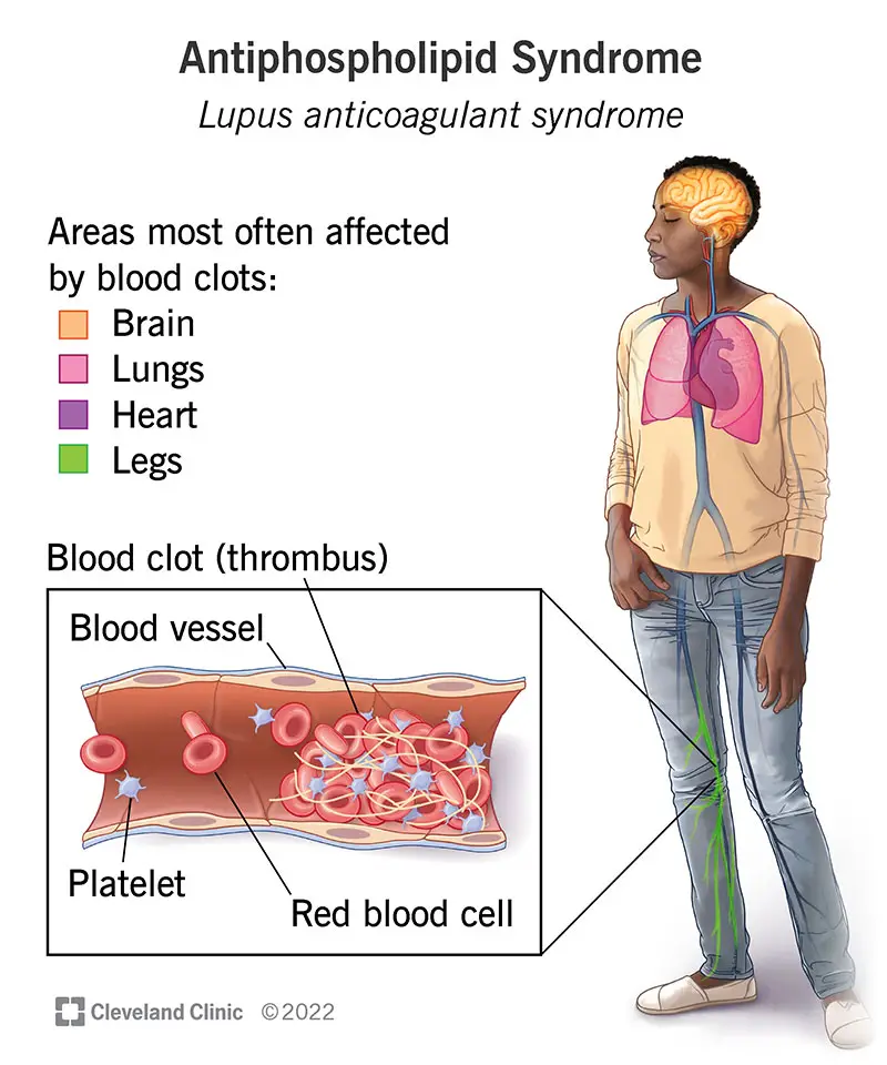 1708246277 23430 lupus anticoagulant