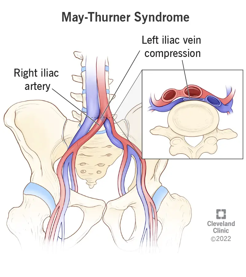 1708284805 17213 may thurner syndrome