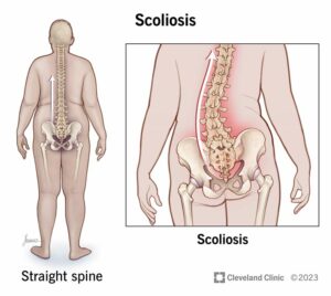 1708327223 15837 scoliosis