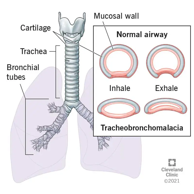 1708423485 22061 tracheobronchomalacia illustration