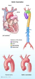 1708485082 16876 aortic coarctation