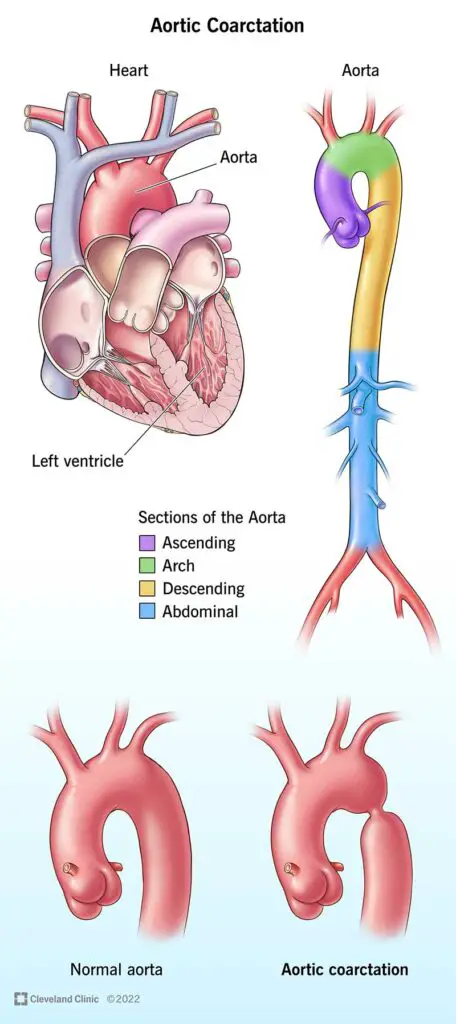 1708485082 16876 aortic coarctation