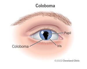 1708496597 22682 coloboma