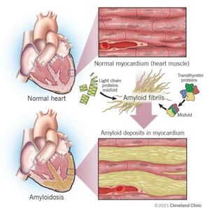 1708589386 22598 cardiac amyloidosis