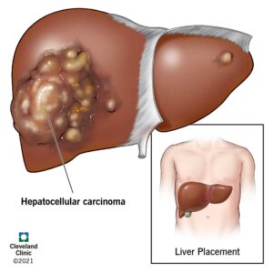 1708608746 21709 Hepatocellular Carcinoma Illustration