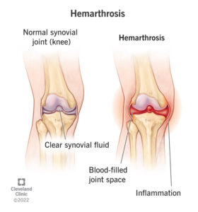 1708697603 24225 hemarthrosis