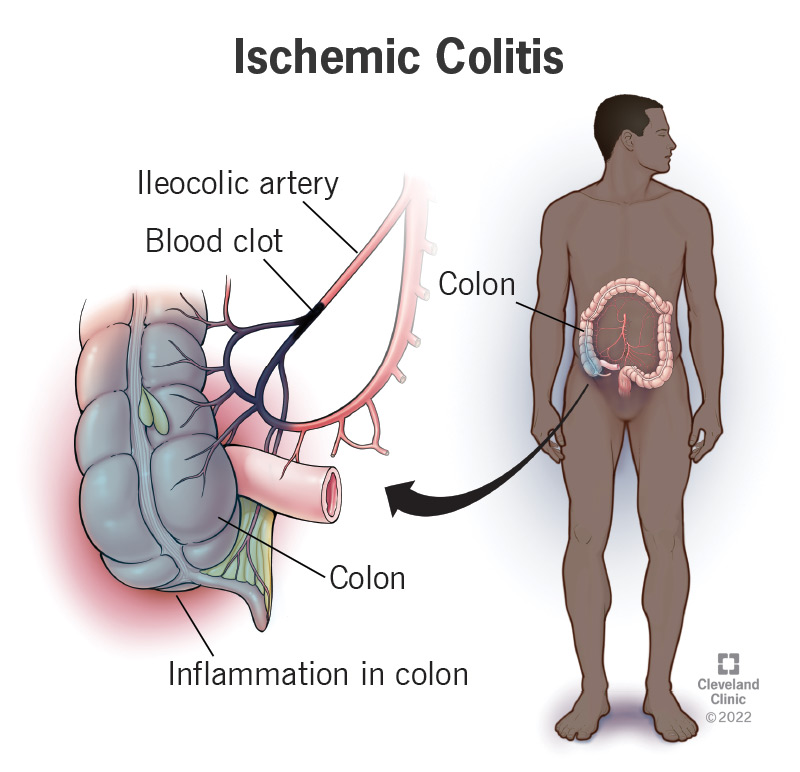 1708740021 24513 ischemic colitis