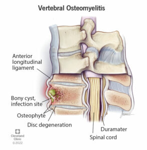 1708751600 22276 vertebral osteomyelitis spine