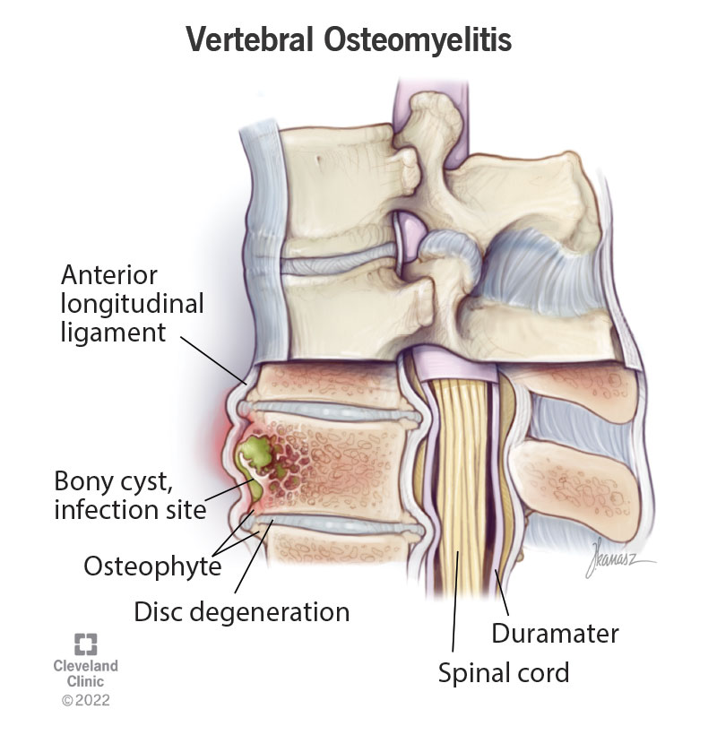 1708751600 22276 vertebral osteomyelitis spine
