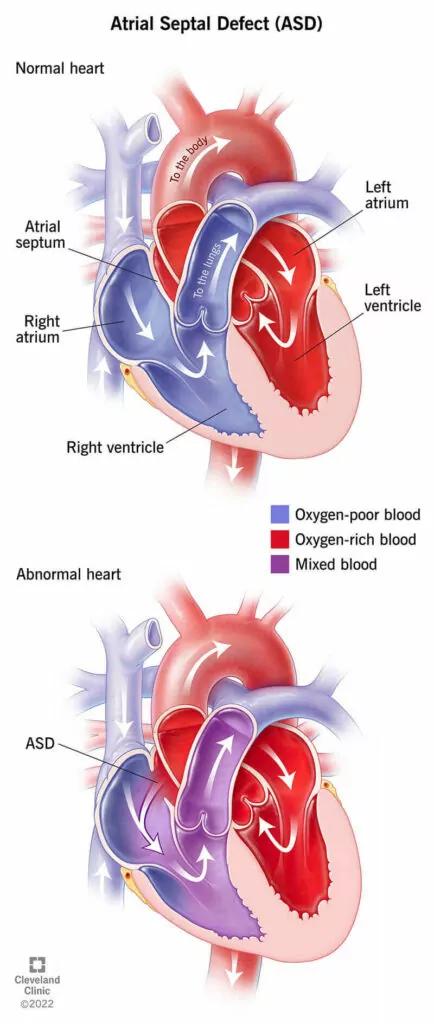 1708770744 11622 atrial septal defect