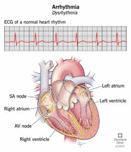 1708797742 16749 arrhythmia illustration