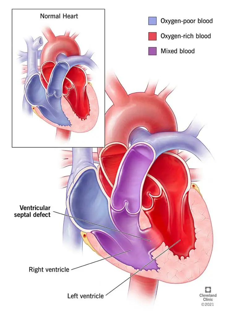 1708855584 17615 ventricular septal defect