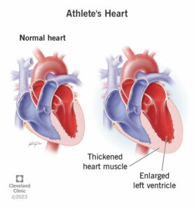 1708901957 23920 athletes heart