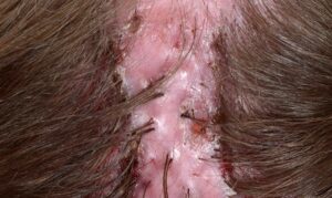 1708905799 22784 folliculitis decalvans